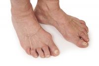 Foot Pain and Rheumatoid Arthritis