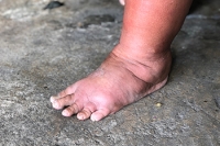 What Swollen Feet Might Mean