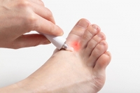 Athlete’s Foot Can Lead To Bacterial Infections