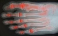 How Rheumatoid Arthritis Affects the Feet